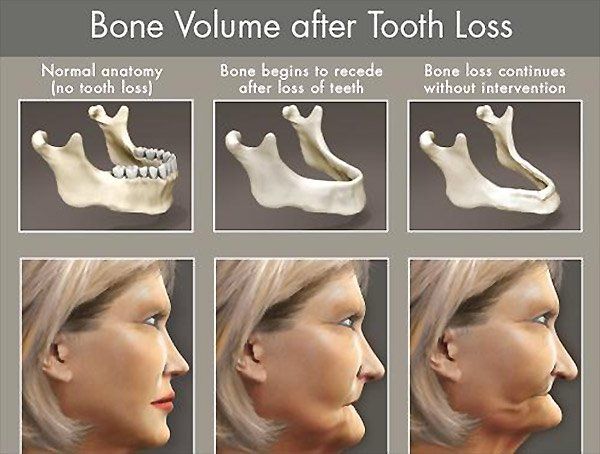 Bone Volume after Tooth Loss Bone Volume after Tooth Loss