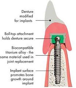 cross-sectional graphic of denture implant cross-sectional graphic of denture implant