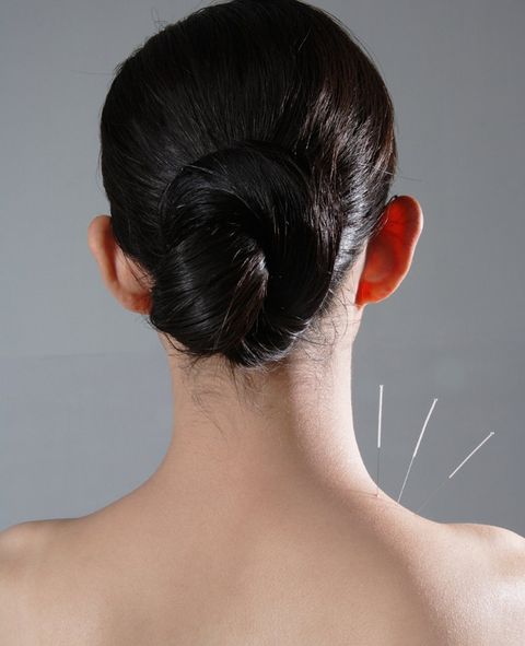 acupuncture 