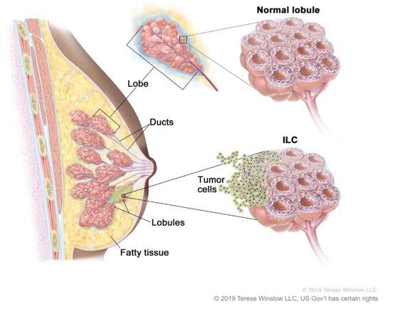Breast Cancer
