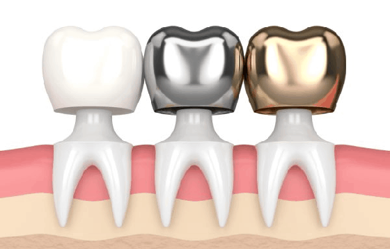 Three dental crowns in white, silver, and gold colors, displayed on model teeth and gums.