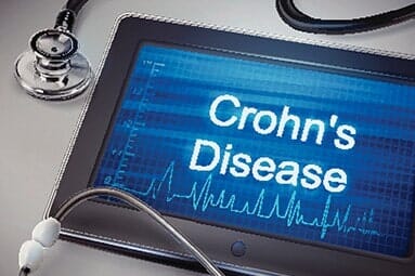 Crohn's Disease - upper GL endoscopy in Troy, NY Crohn's Disease - upper GL endoscopy in Troy, NY