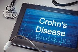 Crohn's Disease - upper GL endoscopy in Troy, NY Crohn's Disease - upper GL endoscopy in Troy, NY