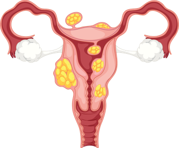 FIBROIDS VIRA macon treatment