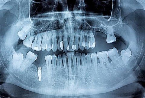 Radiografia