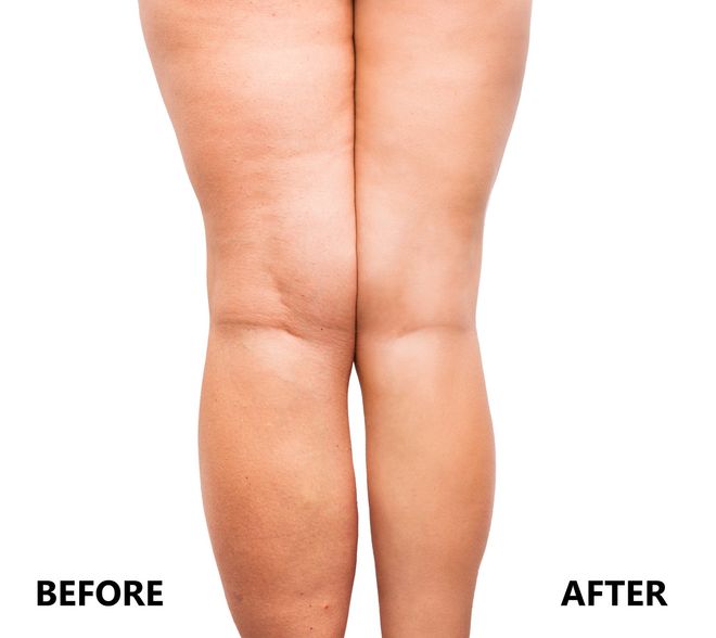 Cellulite Treatment -Affordable Medical Care in Elmhurst, NY