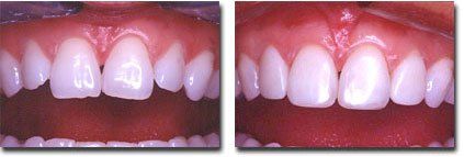 Before and After Cosmetic Work — Westlake, OH — Aico’s Dental Group Before and After Cosmetic Work — Westlake, OH — Aico’s Dental Group