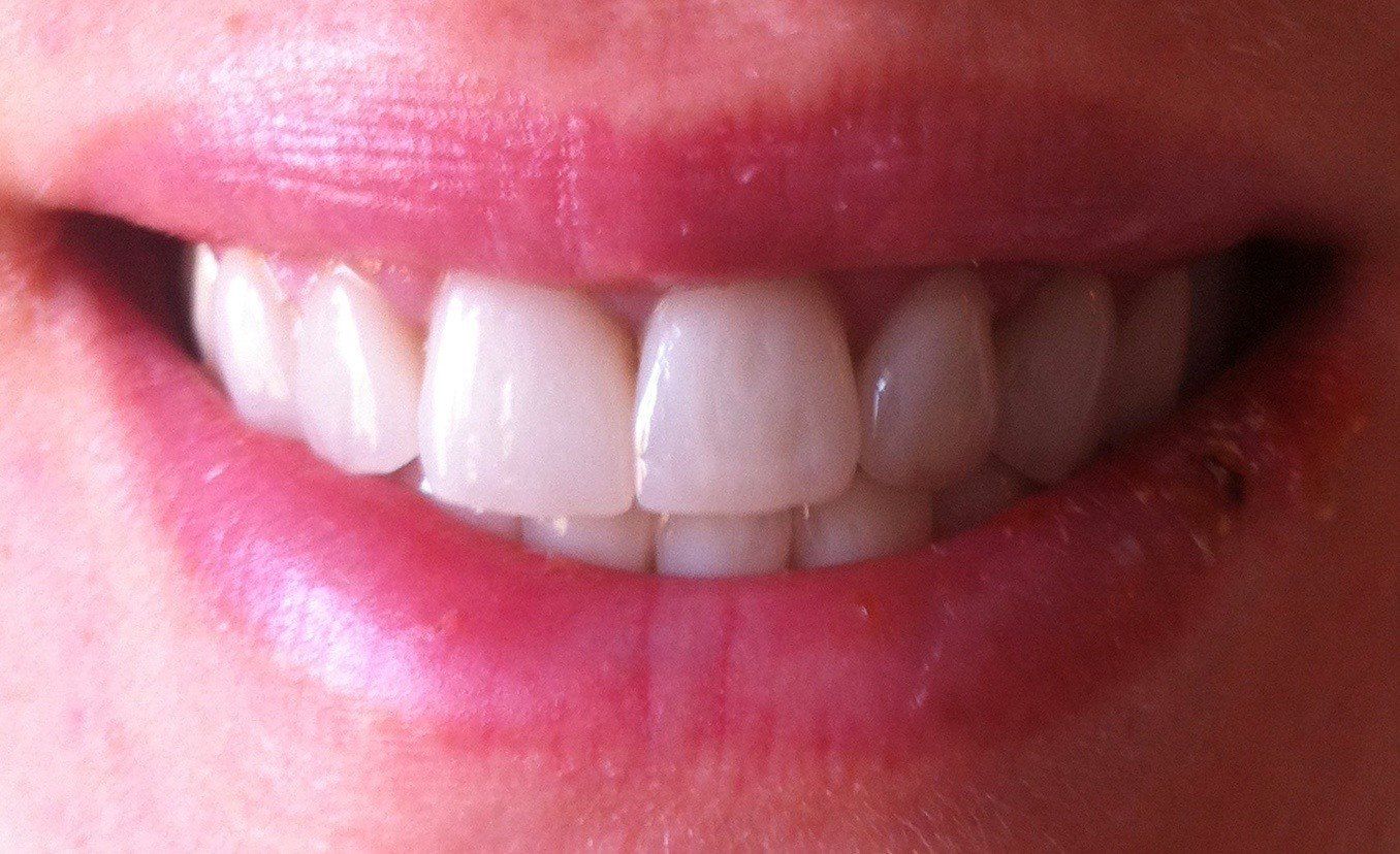 prima-metal-ceramica