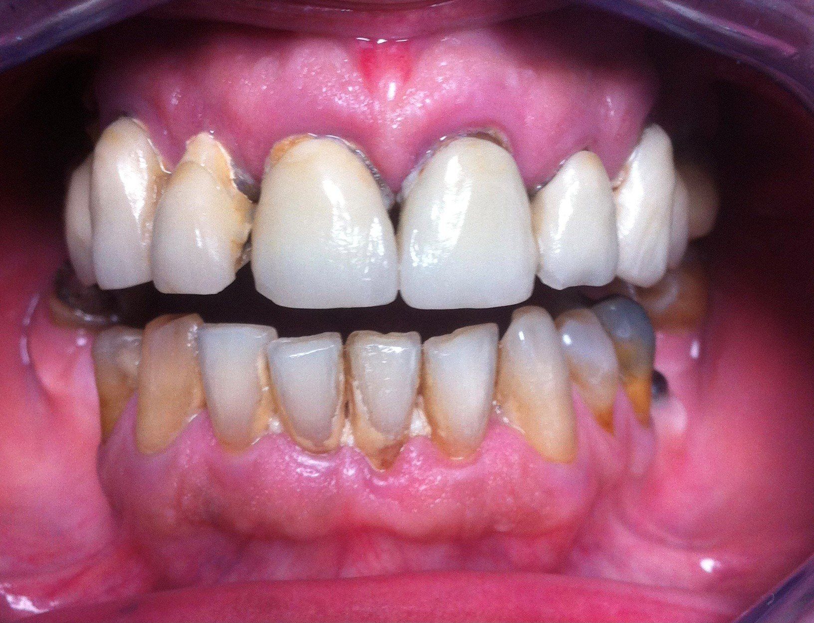 prima-faccette-dentali