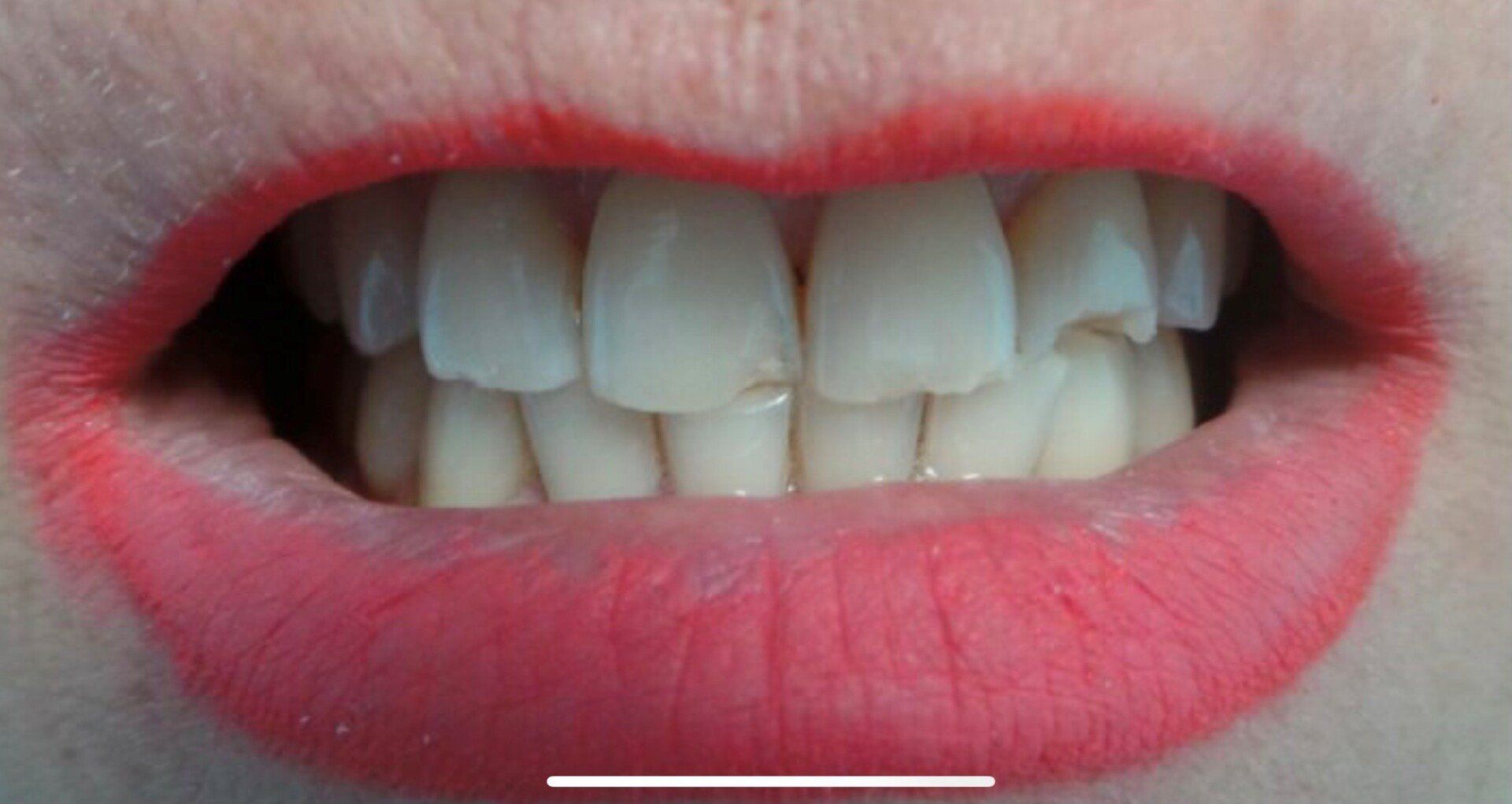 prima-corone-disilicati