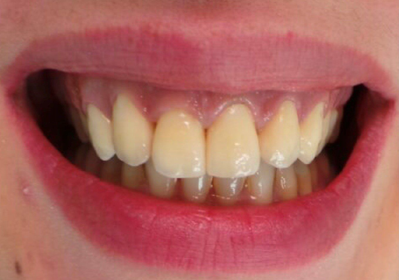 corone-zirconia-dopo
