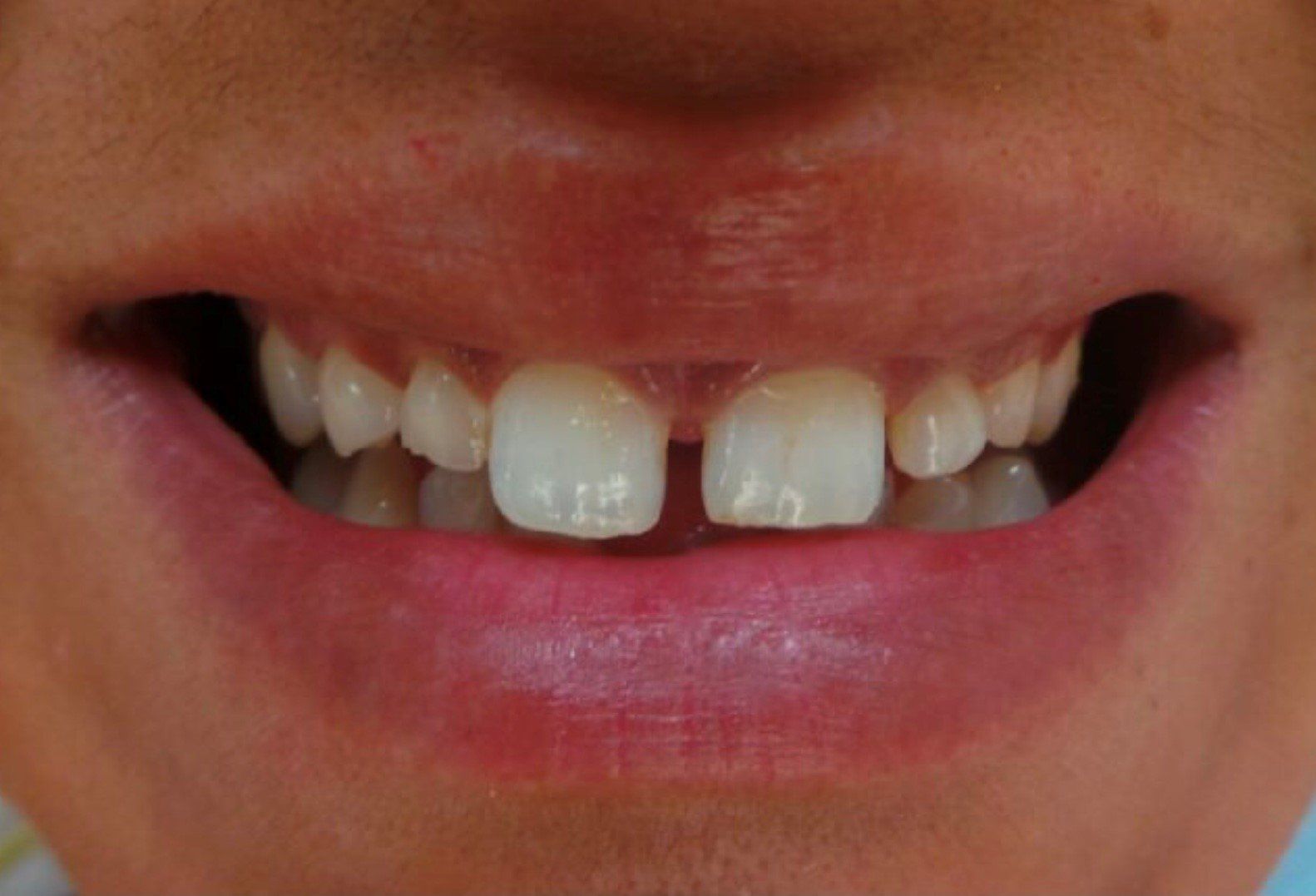 prima-zirconia