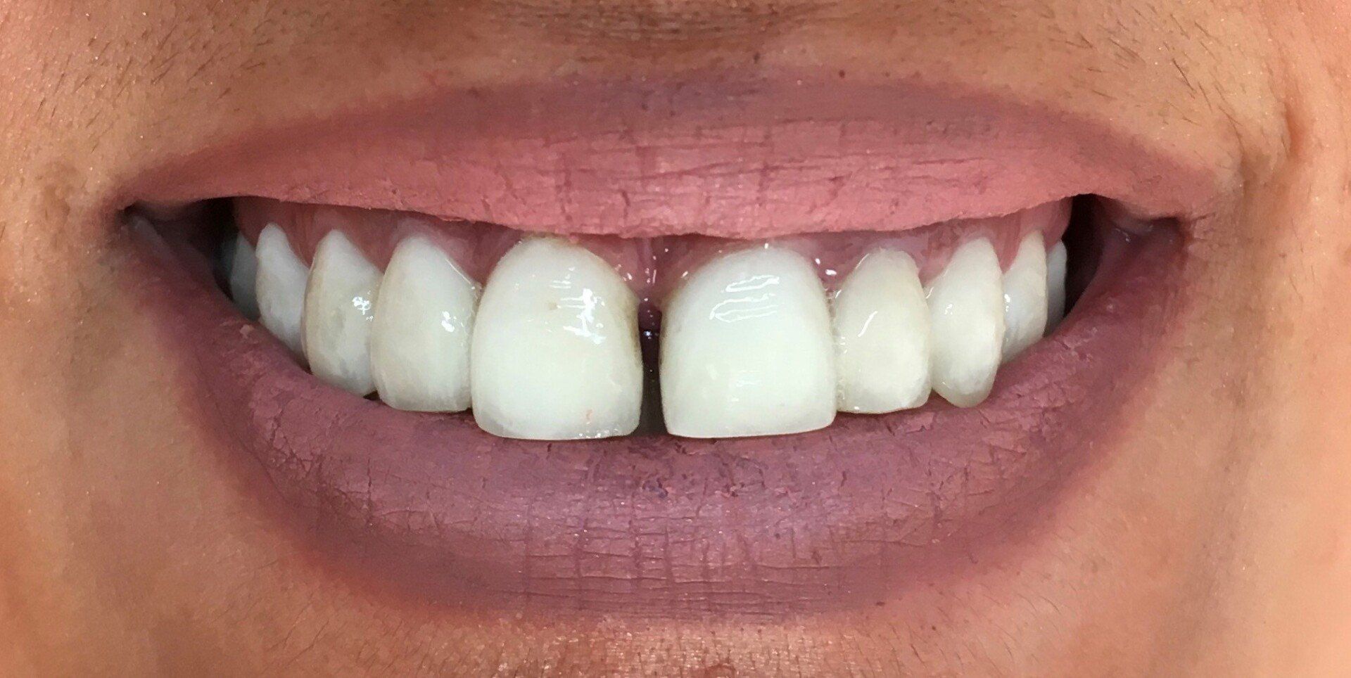 dopo-zirconia