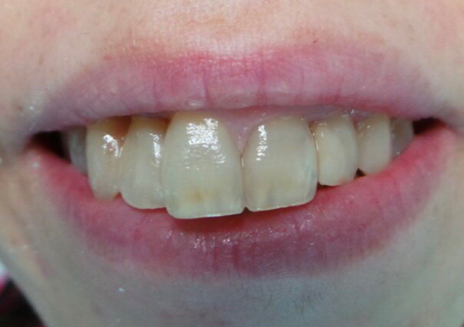 prima-faccette-dentali