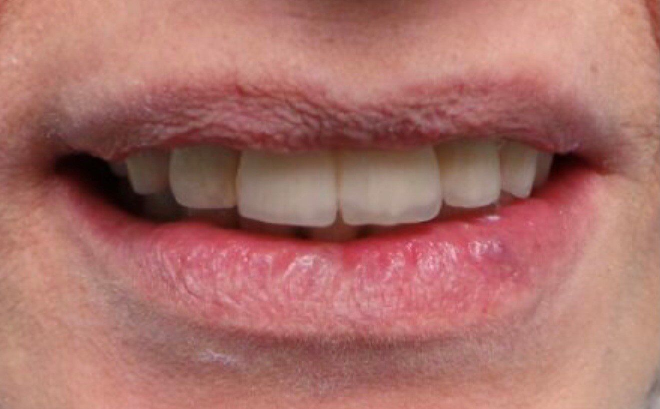 dopo-faccette-dentali
