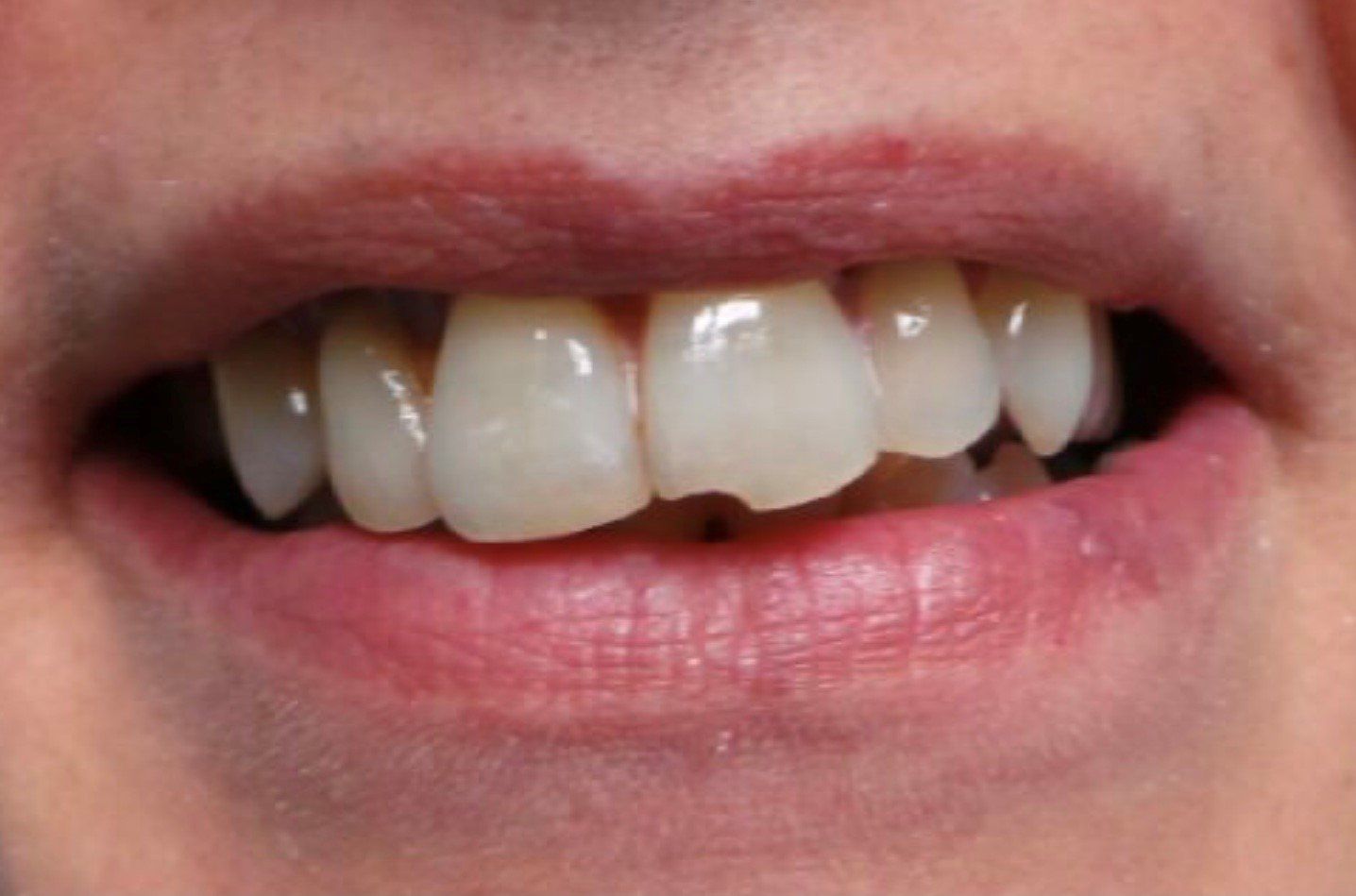 prima-faccette-dentali