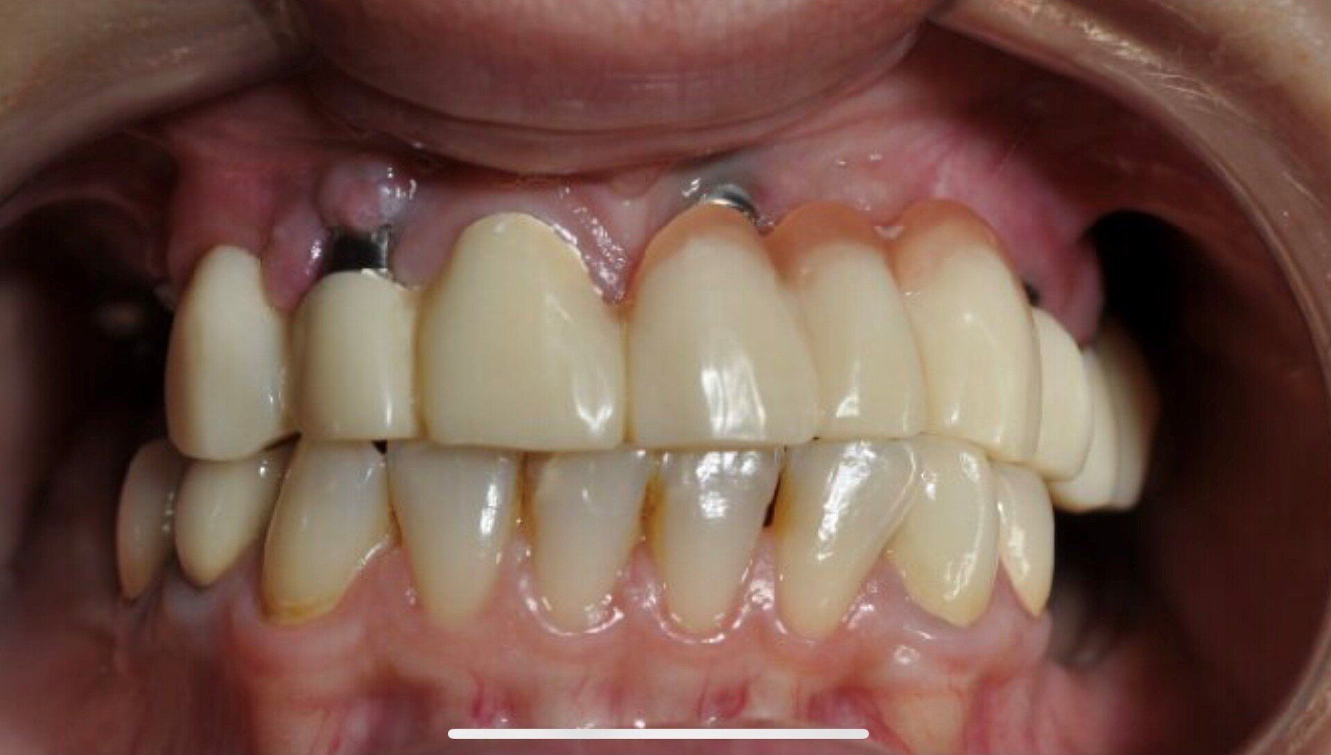 prima-ponte-ceramica-su-sovrastrutture-implantari