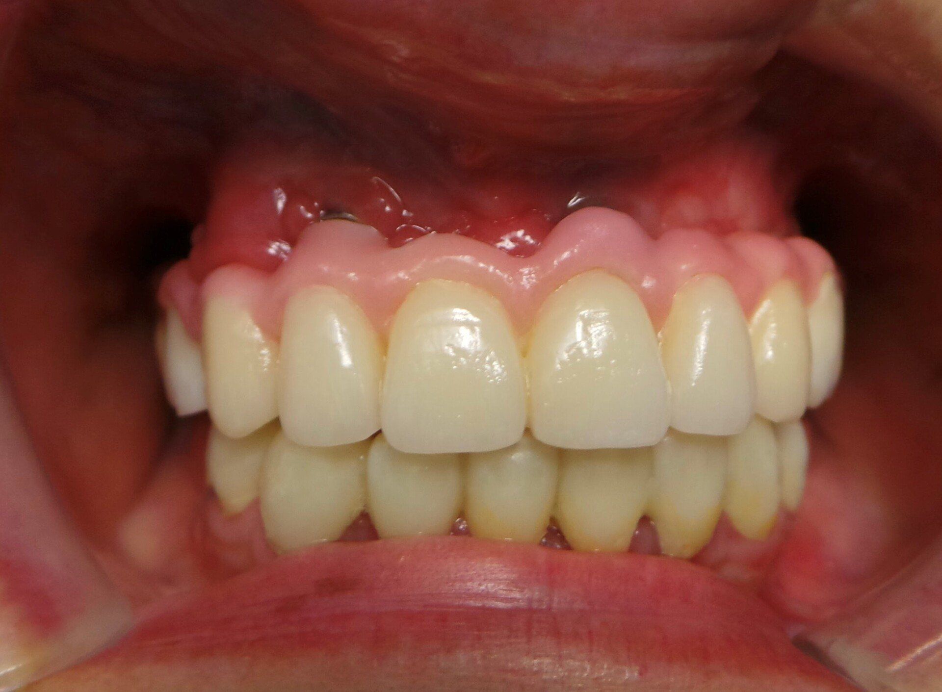 dopo-ponte-ceramica-su-sovrastrutture-implantari