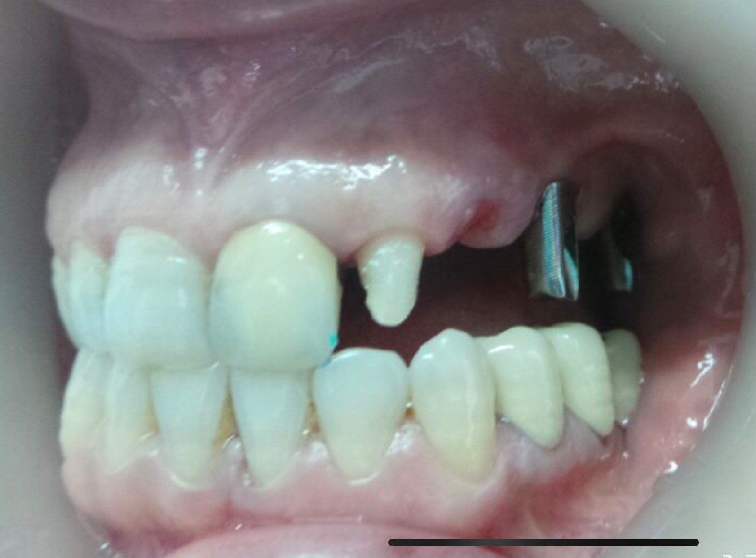prima-ponte-ceramica-su-sovrastrutture-implantari