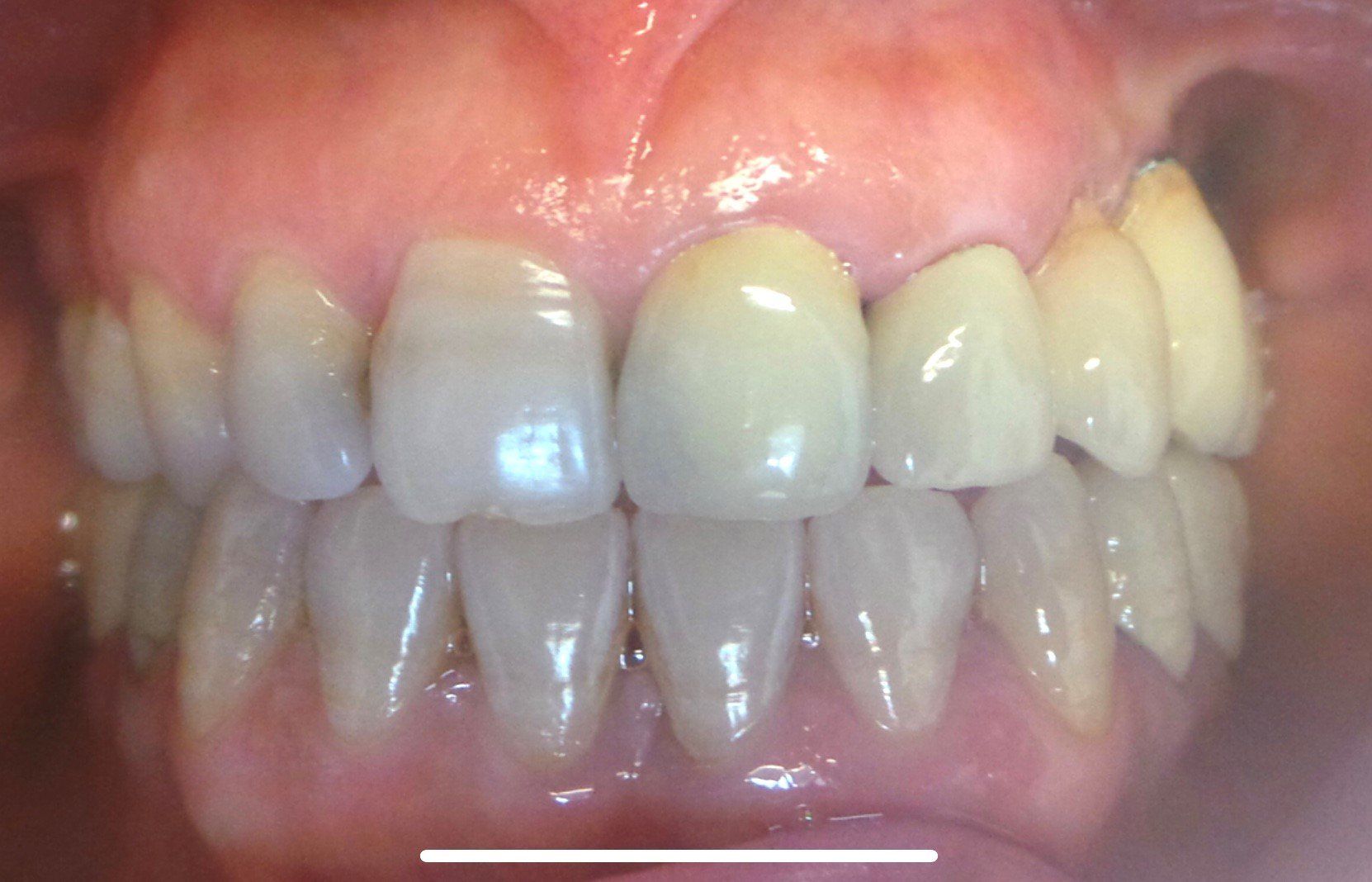 dopo-ponte-ceramica-su-sovrastrutture-implantari