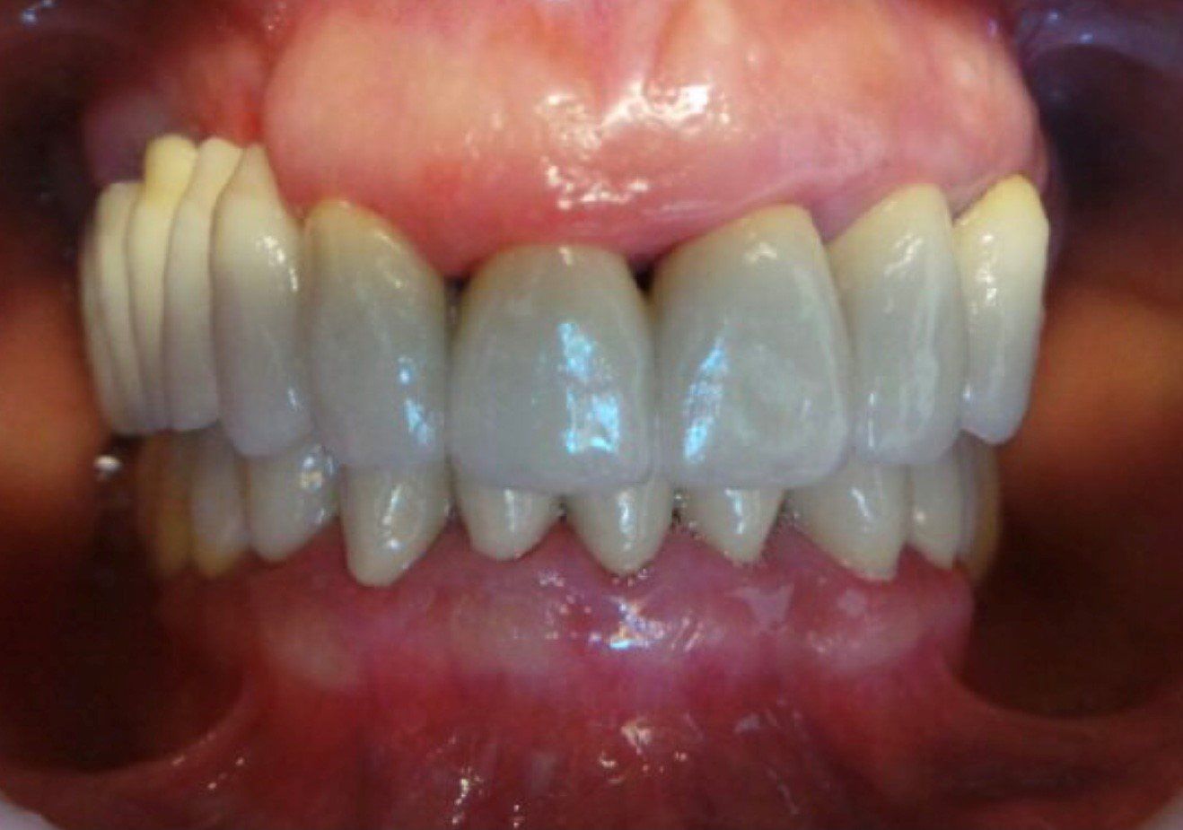 zirconia-dopo