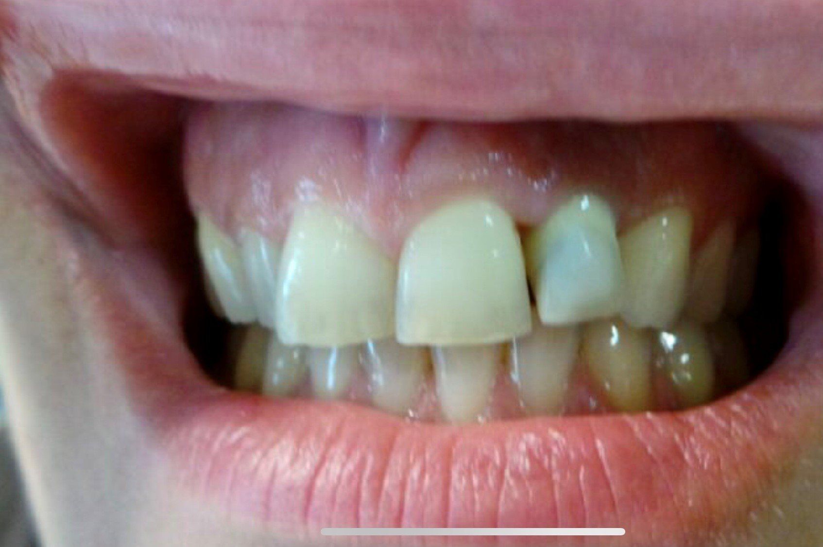 prima-ponte-ceramica-su-sovrastrutture-implantari