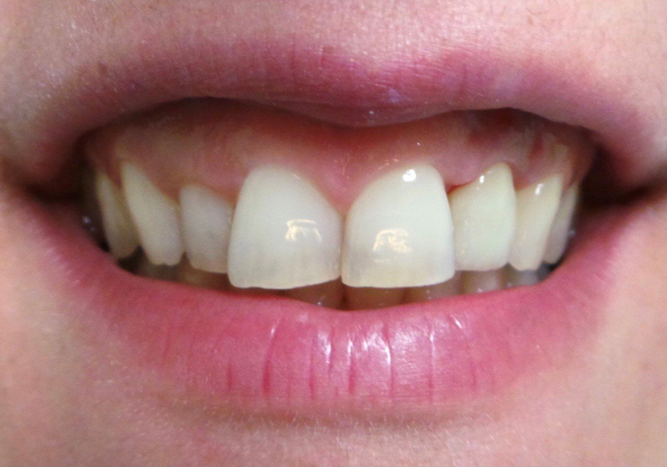 dopo-ponte-ceramica-su-sovrastrutture-implantari