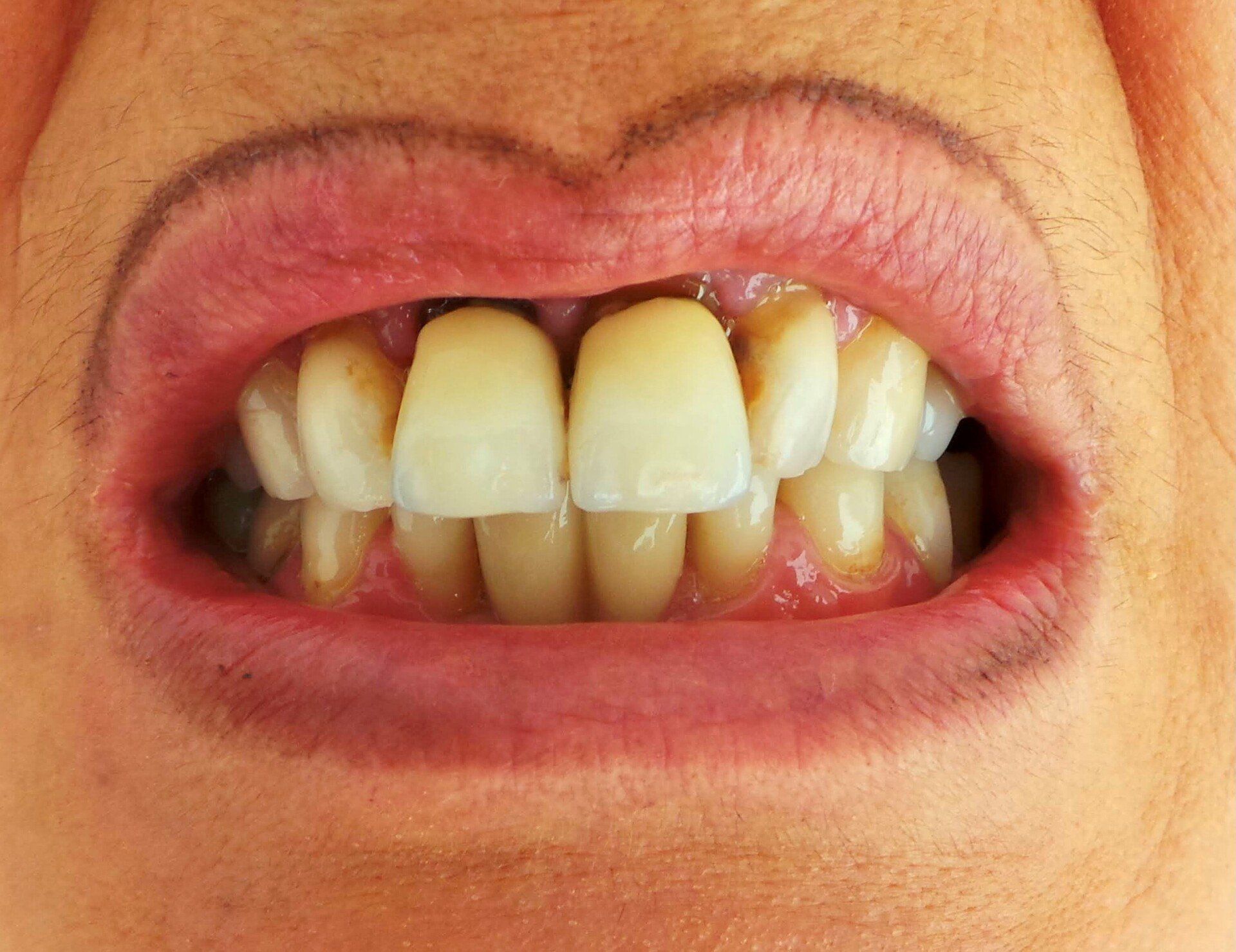 prima-metal-ceramica