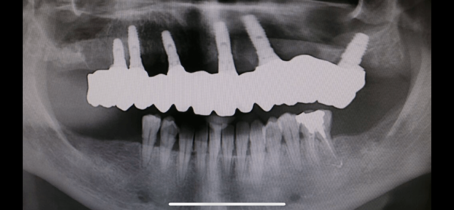 prima-ponte-ceramica-su-sovrastrutture-implantari