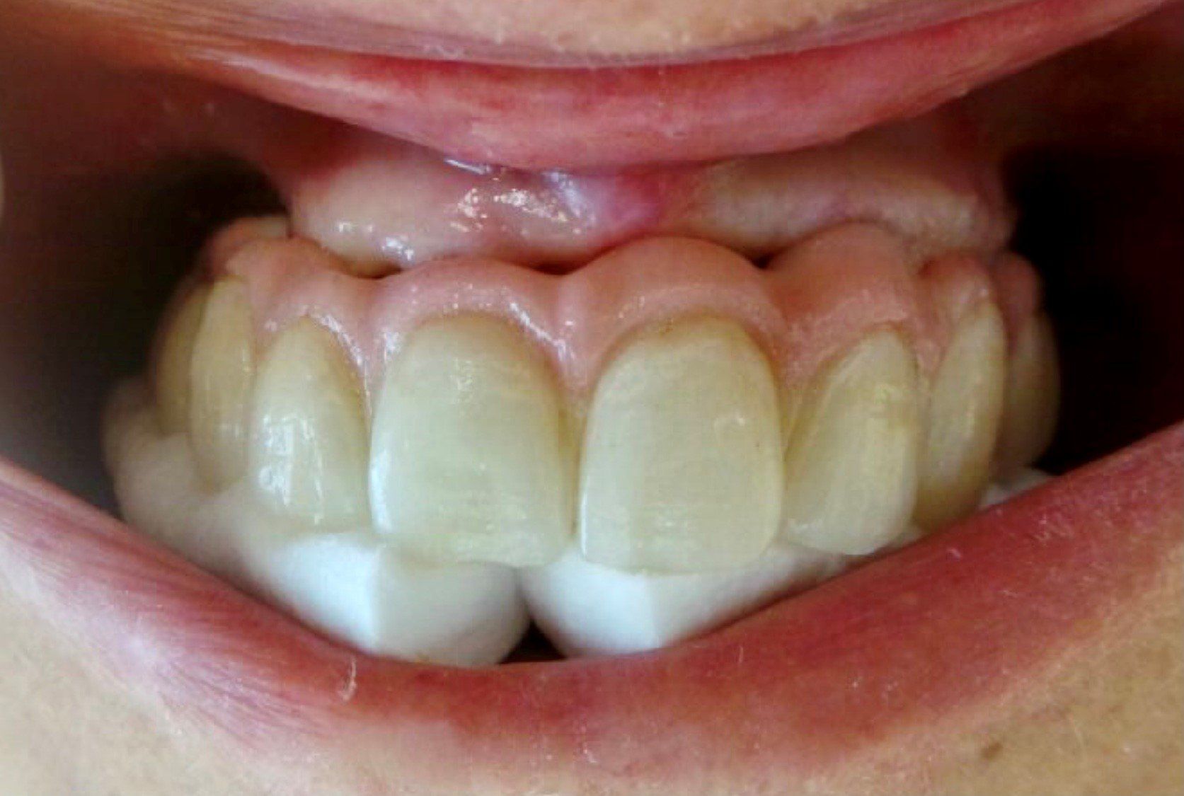 dopo-ponte-ceramica-su-sovrastrutture-implantari