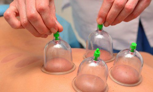 Benefits of cupping