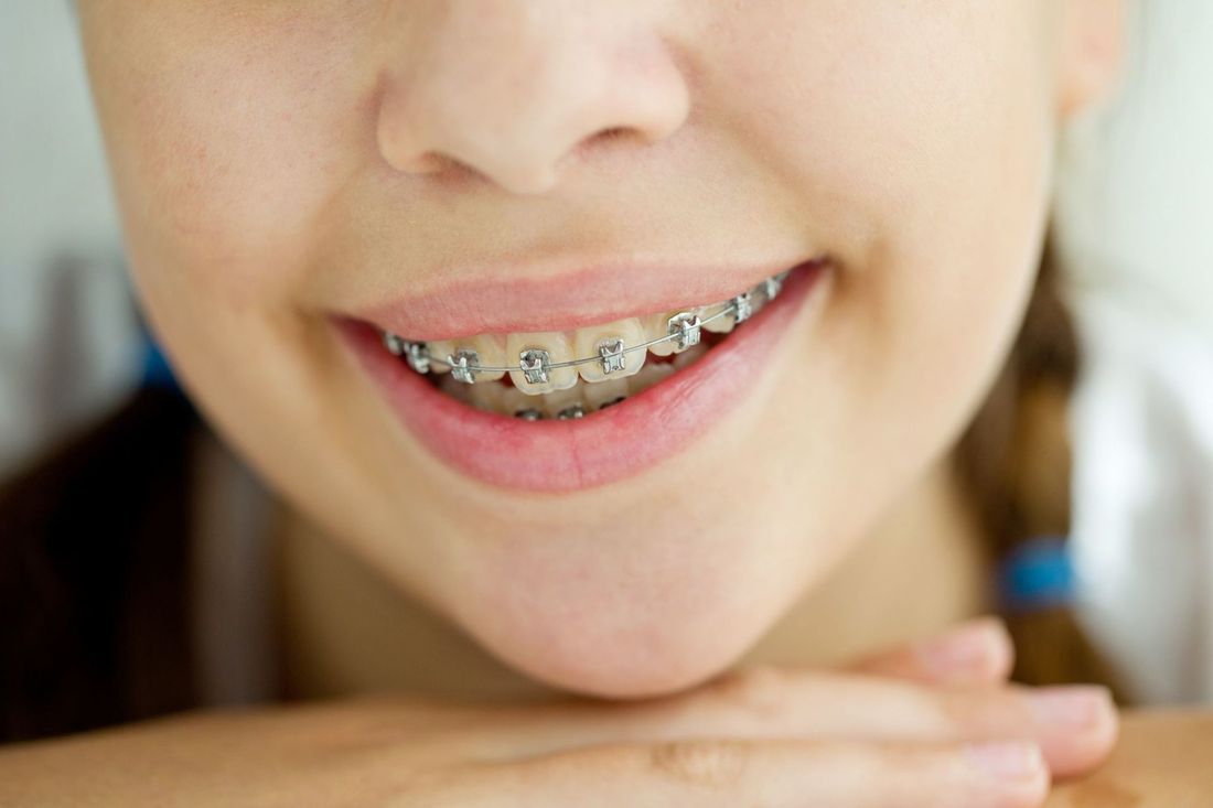 bambina con apparecchio per i denti