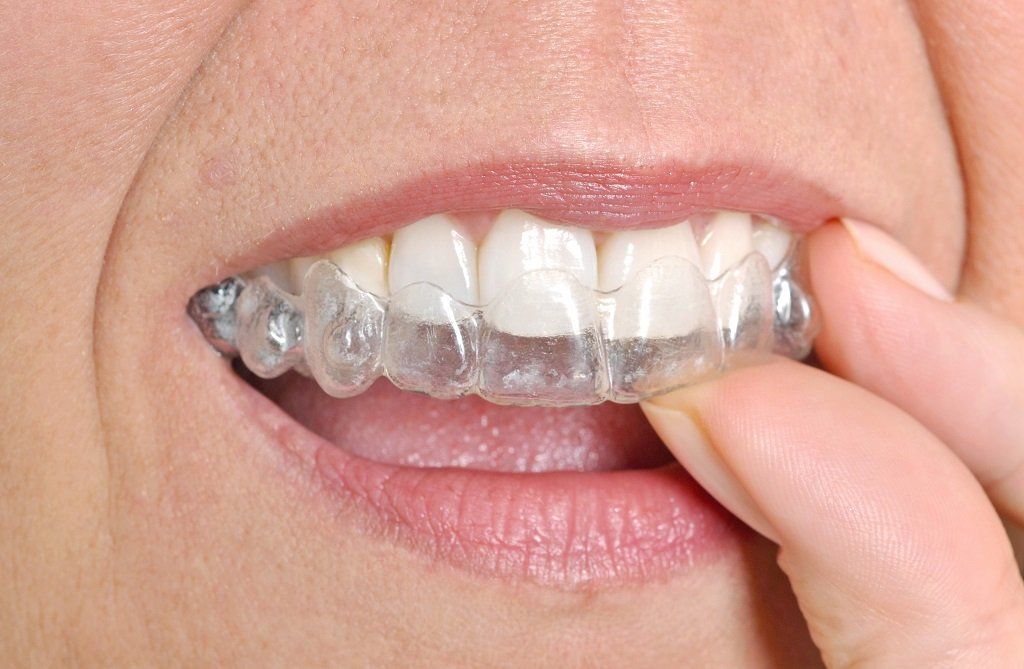 Allineatore invisibile per denti