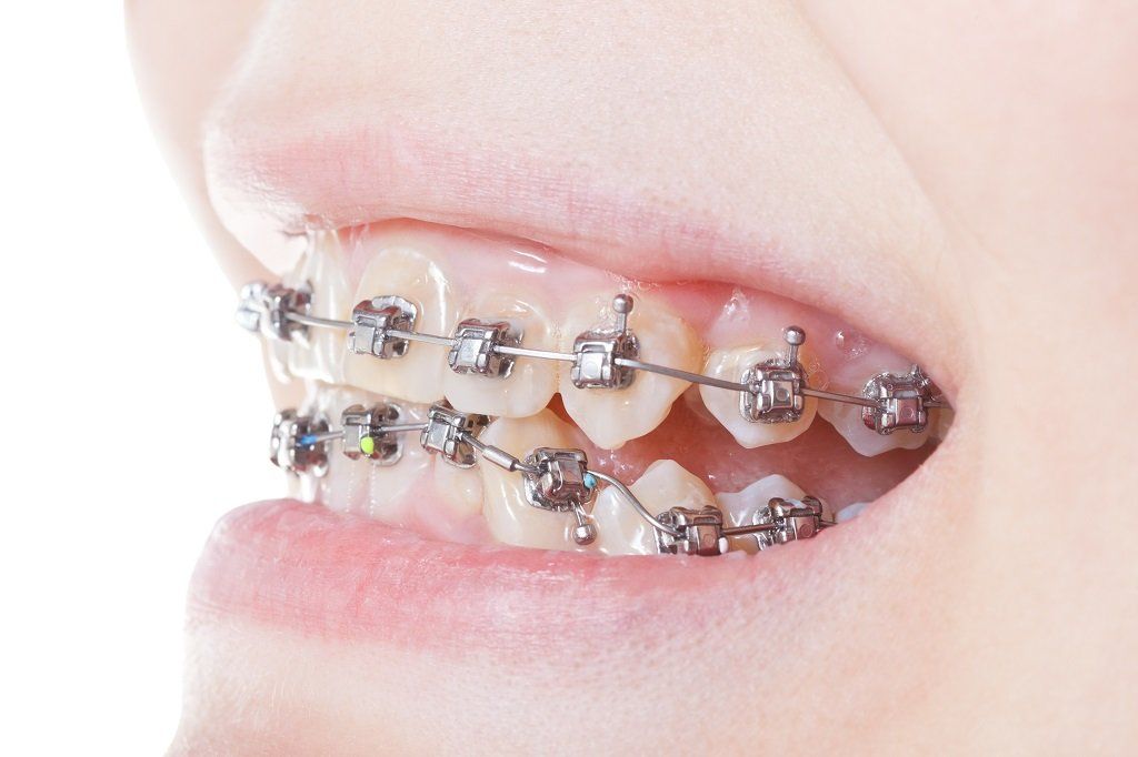 Apparecchio dentale fisso