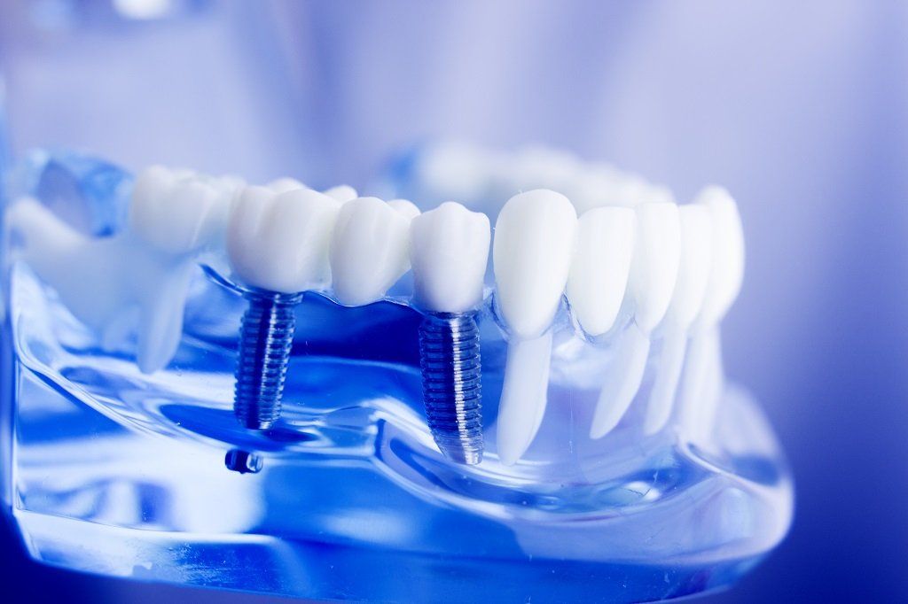 modello di impianto dentale