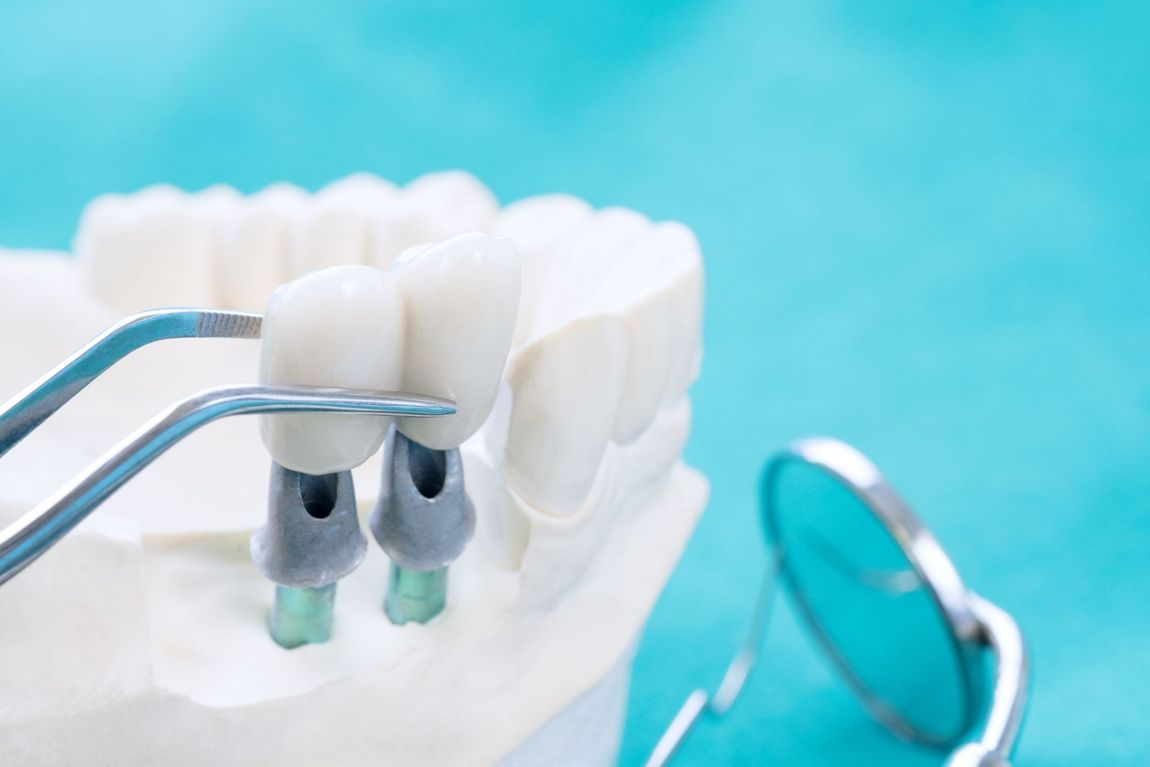 Trattamento implantare