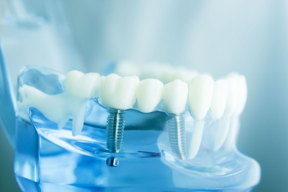 Impianti dentali