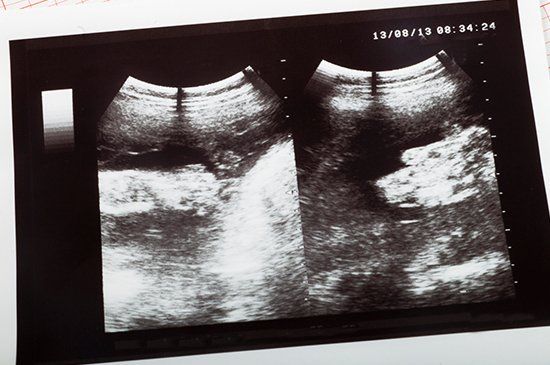 Sonohysterography — Ultrasound Scanner in Manchester, NH Sonohysterography — Ultrasound Scanner in Manchester, NH