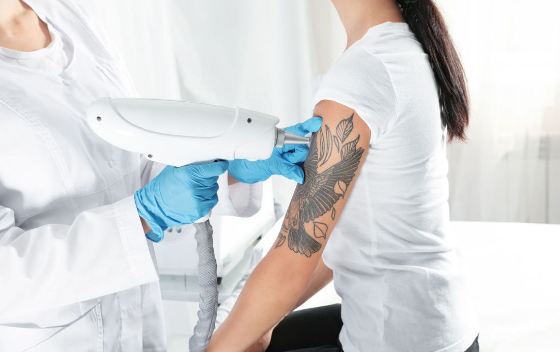 rimozione tatuaggi con laser