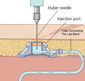 lap band adjustment illustration