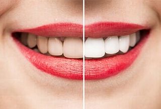 Teeth Whitening—Cosmetic Dentistry in Moorpark, CA Teeth Whitening—Cosmetic Dentistry in Moorpark, CA