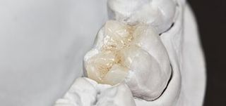 Inlay Crown—Cosmetic Dentistry in Moorpark, CA