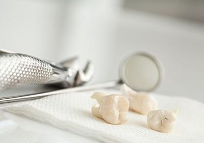 Extraction of Wisdom Tooth—Cosmetic Dentistry in Moorpark, CA Extraction of Wisdom Tooth—Cosmetic Dentistry in Moorpark, CA