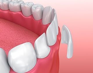 Dental Veneers—Cosmetic Dentistry in Moorpark, CA Dental Veneers—Cosmetic Dentistry in Moorpark, CA