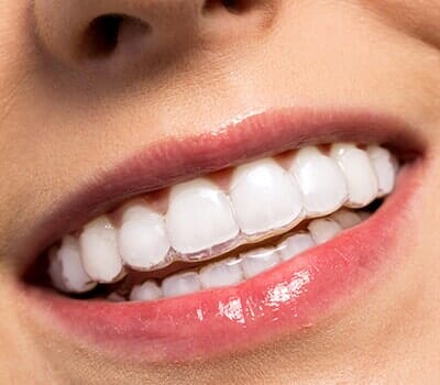 Invisible Braces—Cosmetic Dentistry in Moorpark, CA Invisible Braces—Cosmetic Dentistry in Moorpark, CA
