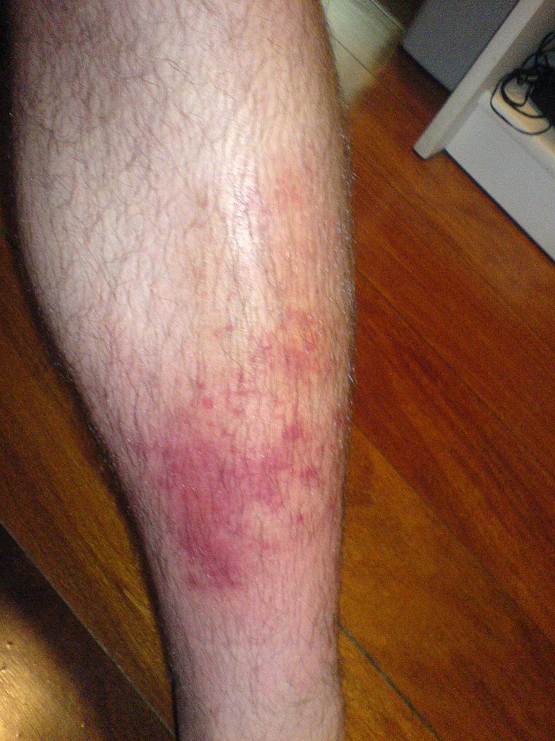 Chloramine skin symptom image