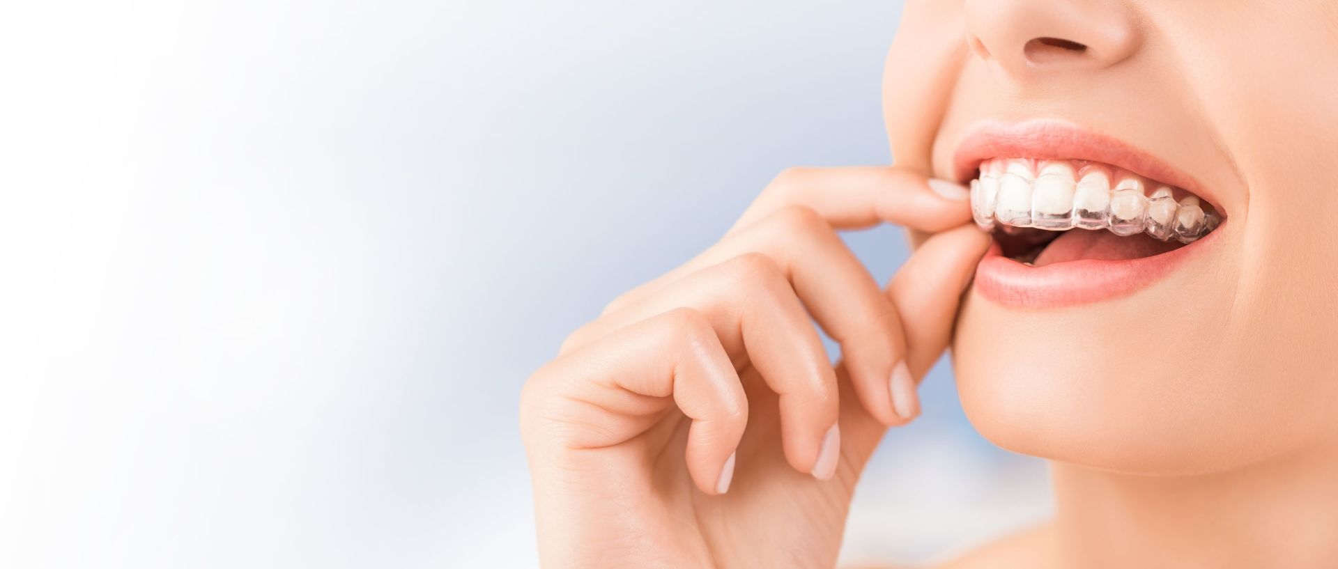 apparecchio Invisalign