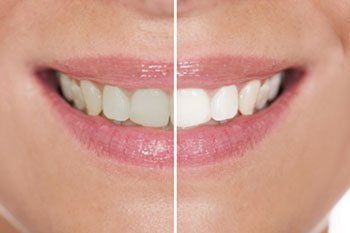 Teeth Whitening Gloversville, NY