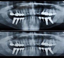root canal Gloversville, NY