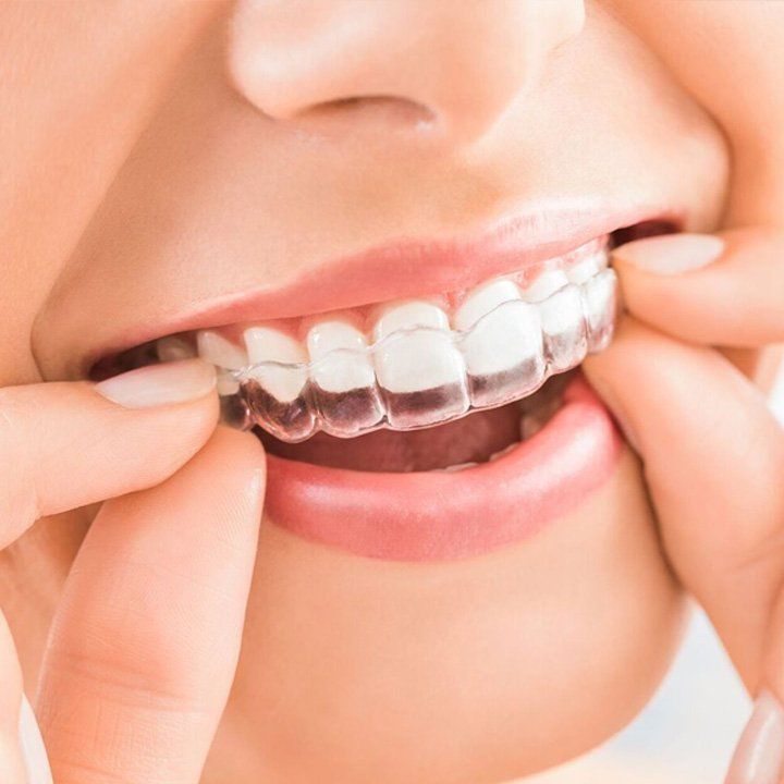INVISALIGN, ALIGNERS